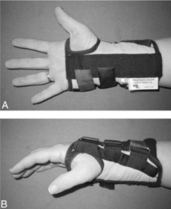 Front and Side view of a participant wearing a D-ring wrist brace. 