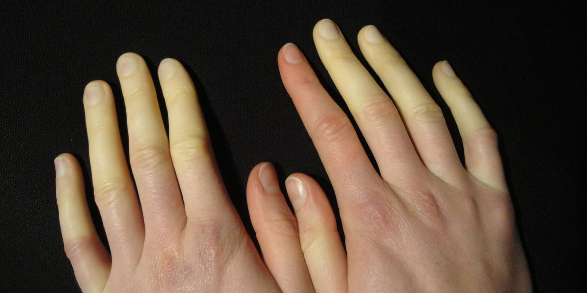 Scleroderma and Raynaud’s Phenomenon: Cold Weather’s Influence on Skin