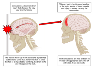 diagram of human brain hitting skull due to a blow to the head