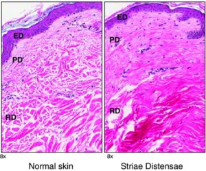 Difference between normal skin tissue and stretch mark tissue