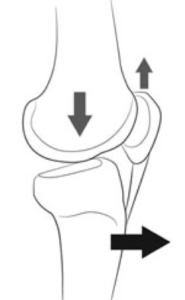 Biomechanical force diagram describing posterior tibial slope 