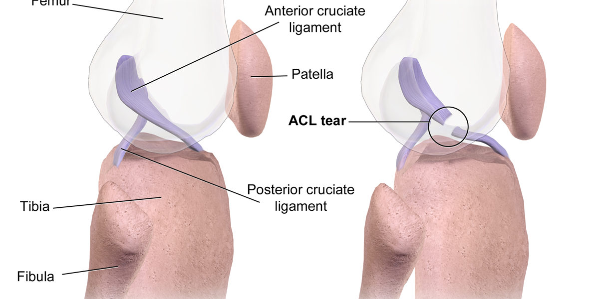ACL Reconstruction: Which Option Is Best For You?
