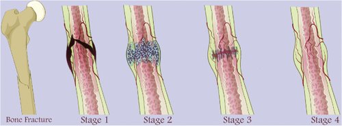 4 stages of secondary fracture healing. Stage 1: Inflammatory response. Stage 2: Soft callus formation. Stage 3: Hard callus formation. Stage 4: Bone remodeling - from Bigham-Sadegh & Oryan, International Wound Journal 2014