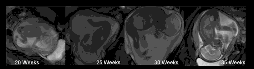 MRI scan animation of developing fetuses