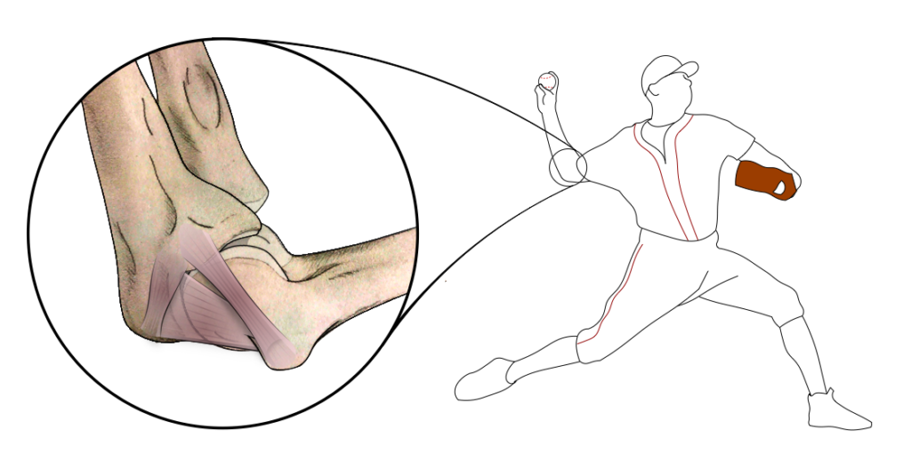 Location of the Ulnar Collateral Ligament in the human arm, shown on a baseball pitcher.