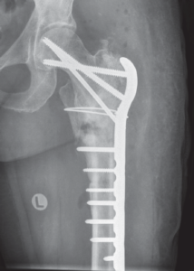Locking compression plate used for treatment of a proximal femoral fracture - by Bjarke Viberg on ResearchGate
