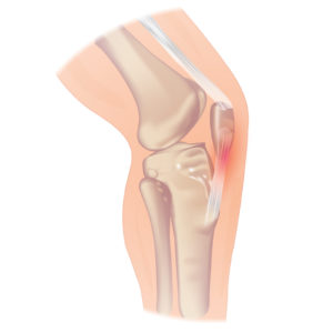 A schematic of the knee and patellar tendon.