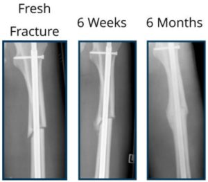 Images of a broken bone and the progression of a callus being formed over time