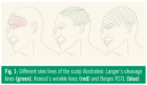 Figure 1 outlines the differences of Langer's lines, Kraissl's lines, and Borges's RSTL on the human face. 