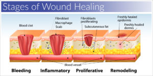 This figure shows each stage of wound healing, as is outlined by the supporting paragraph. 