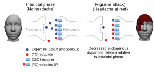 Figure showing dopamine levels decreasing during the onset of a migraine.