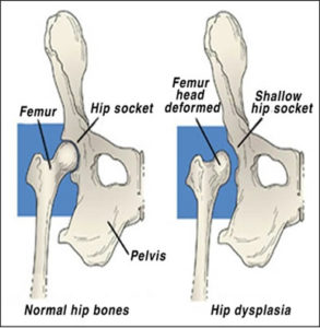 Correctly formed hip versus a deformed femur head and shallow hip socket.