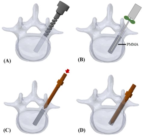 (A) shows device drilling cylindrical hole into vertebra. (B) shows cement being inserted into hole. (C) shows pedicle screw inserted into cement filled hole. (D) shows screw solidified in place.
