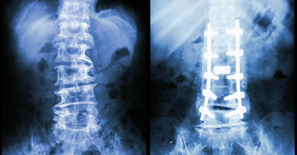 Xray of human spine with misaligned vertabrae. Then shows same spine that is aligned using pedicle screws.