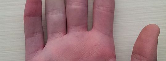 Scleroderma and Raynaud’s Phenomenon: Cold Weather’s Influence on Skin