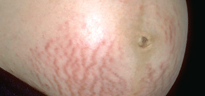 Photo of stretch marks on stomach