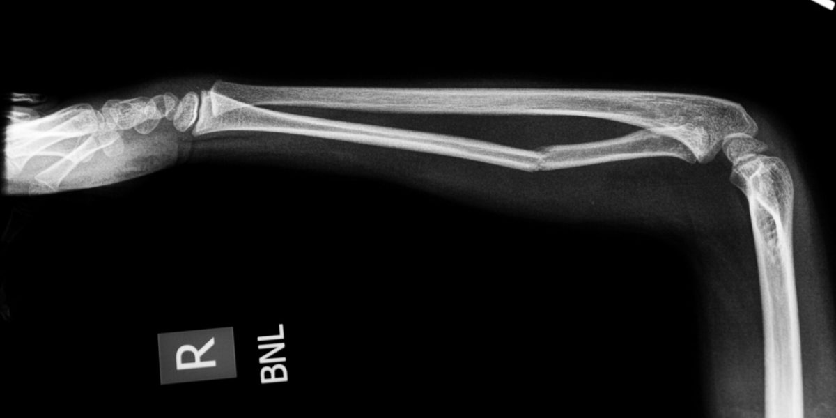 Why do bone fractures take a long time for healing?