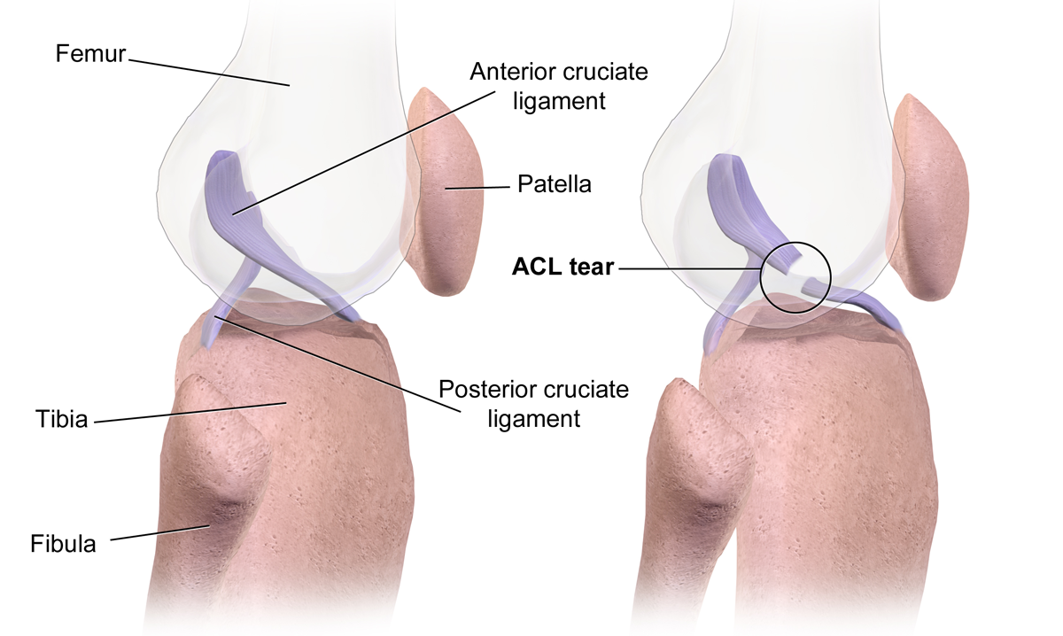 acl-reconstruction-which-option-is-best-for-you-biomechanics-in-the