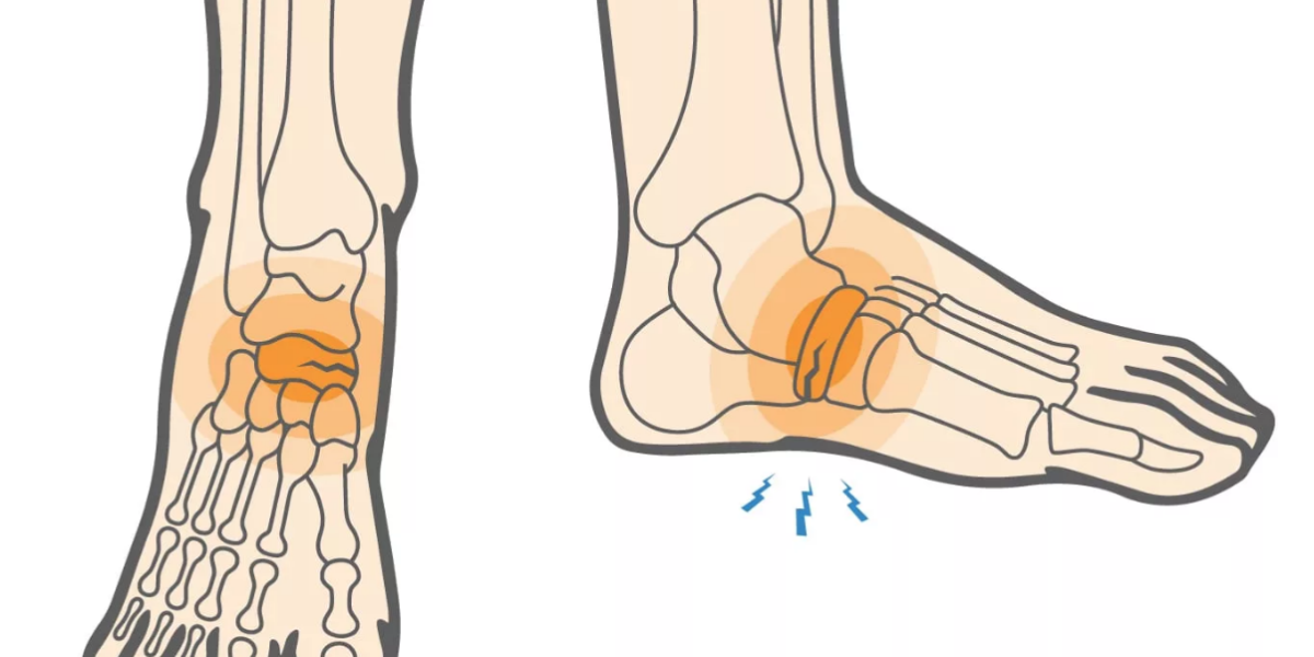 A Mystery: How Can Distance Runners Avoid the Most Common and Dreaded Injury?