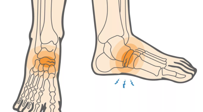 Drawing of the bones in the foot with emphasis on the small crack, a stress fracture, in the navicular bone.