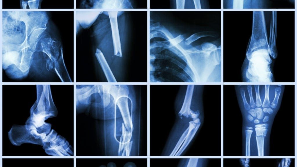 Guide To Bone Fractures Bone Fracture Fractures Fract