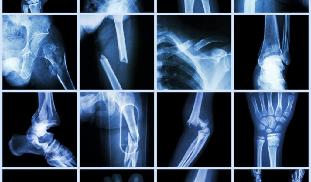 Why do bone fractures take a long time for healing?