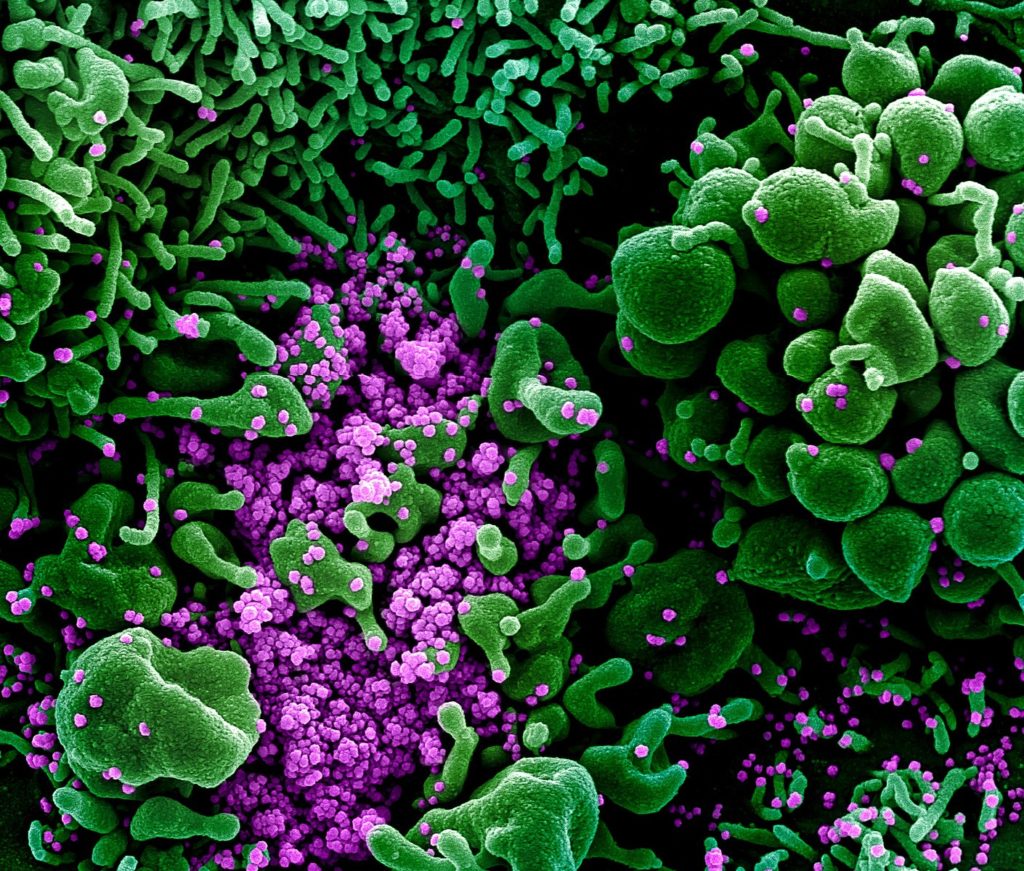 Scanning Electron Micrograph of Coronavirus infected tissue