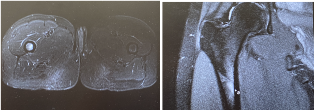 Photograph of a stress reaction in the femur of a female runner