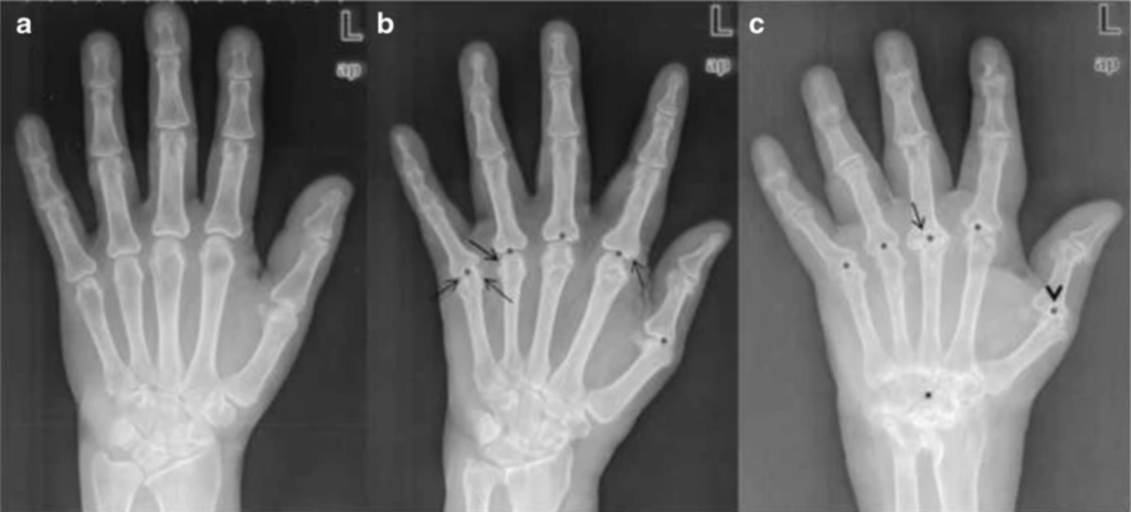 x ray of 3 hands at varying stages of arthritis damage. Figure a on the left is a normal hand with no swelling while figure c has visible damage noted by crooked fingers and smaller spaces where cartilage should be in between bones of finger joints. Figure b in the middle is in between these levels.