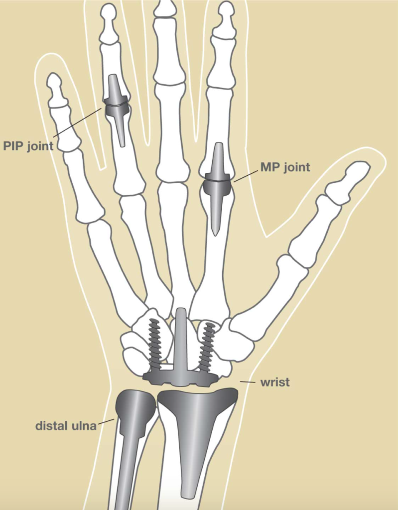 diagram of joint replacements on wrist, MP joint and PIP joint.