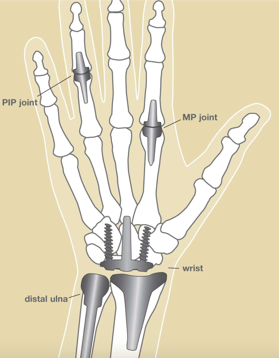 Arthritis is NOT Just For The Elderly: Early Signs Of Rheumatoid ...