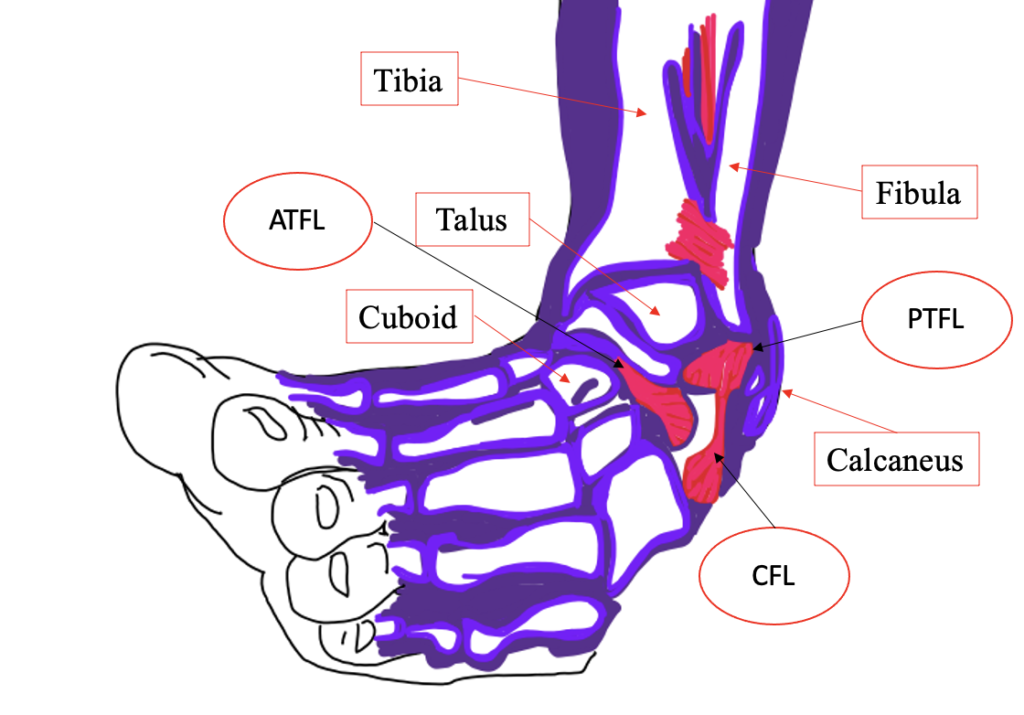Depiction of ankle position with an inversion sprain. Light purple items are bones and have rectangular callouts, while red items are ligaments with circular call outs. Labeled items include: Tibia, Fibula, Talus, Cuboid, and Calcaneus bones as well as the ATFL, PTFL, and CFL (ligaments).