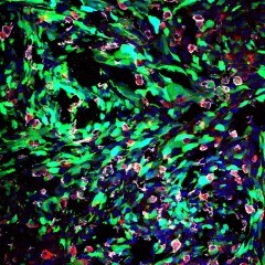 Image of nanoparticles (small red circles) in a rat brain that has a tumor (green string-like material)