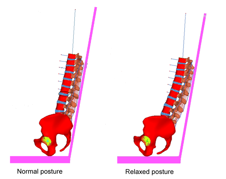Software model of thoracolumbar spines in normal and relaxed postures.