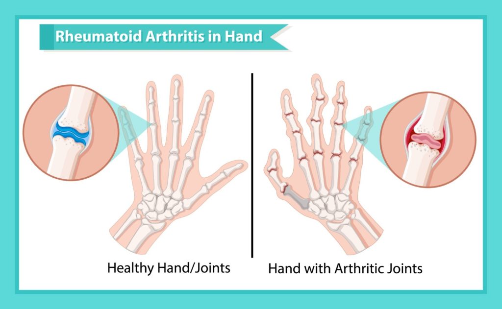 Comparison between healthy hand and hand with arthritic joints
