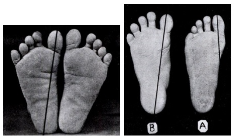 Do Shoes Alter the Form and Function of Your Feet? | Biomechanics in ...