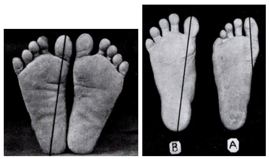 Figure 2. The typical shape of a habitually unshod foot (top); Footprint of a teenager before (B) and after (A) six weeks of conventional shoe wear. The splay and width decrease of the foot after six weeks of wearing a shoe is significant.