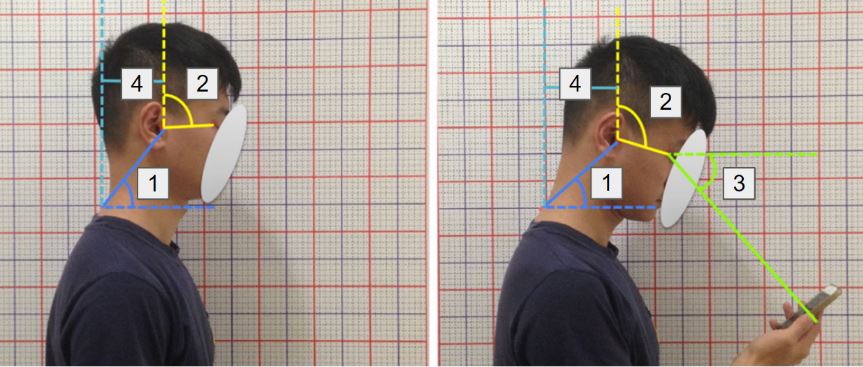 This image compares the posture of someone not viewing their phone with someone who is viewing their phone. The picture on the left is a male with neutral posture and has the neck tilt, head tilt, and forward head shift labeled. The picture on the right is the same male now viewing his phone. The neck tilt, head tilt, gaze, and forward head shift are all labeled. His head is clearly rotated down and shifted forward.