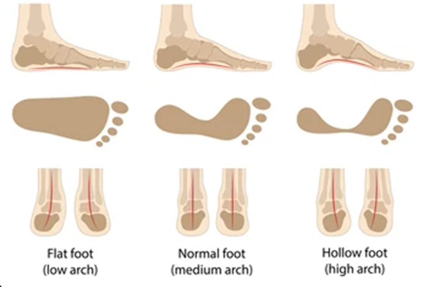 Picture showing what a flat foot, normal foot, and high arched foot and what the footprint looks like