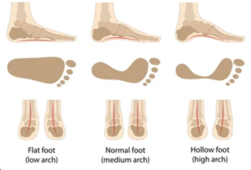 types of foot arches