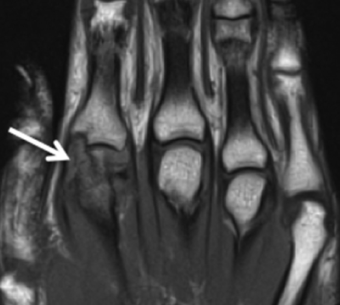 MRI of 29-Year-Old Man with Arthritis