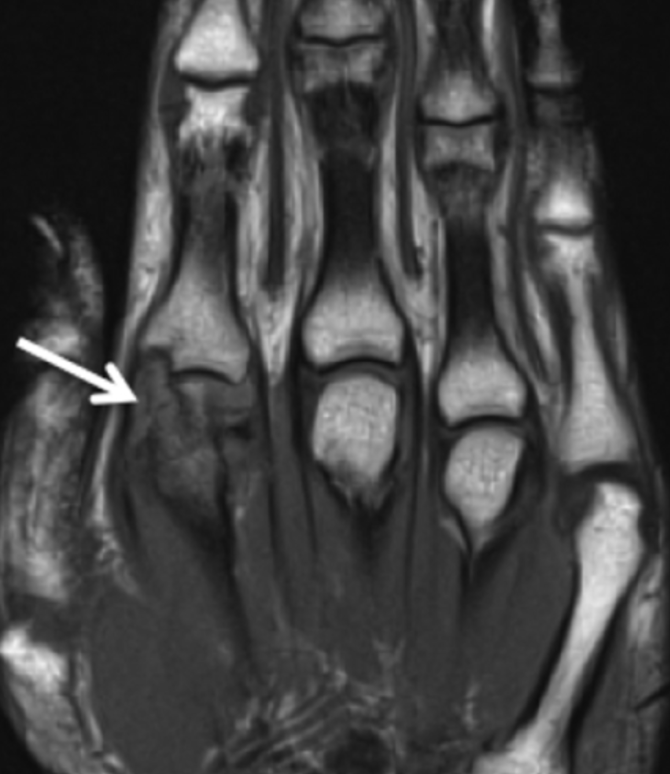 MRI Image of fingers that have been cracked for an extended of time.
