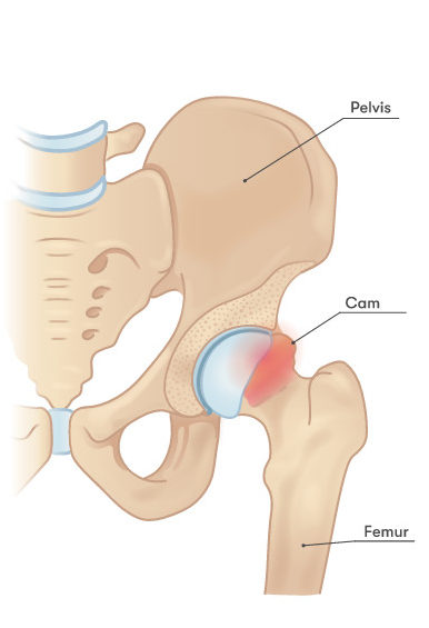 Image of the anatomy highlighting a CAM impingement.
