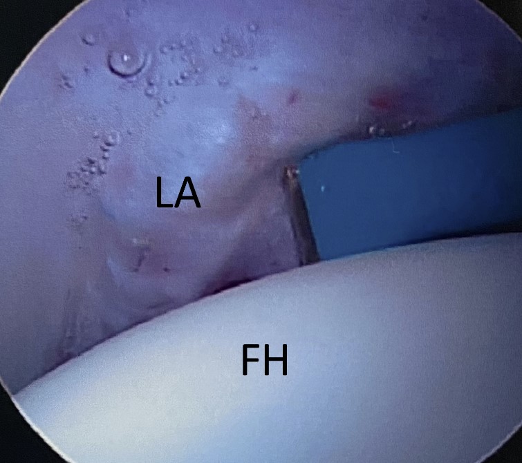 Image of labrum being pulled away from the femoral head to break the fluid seal. 