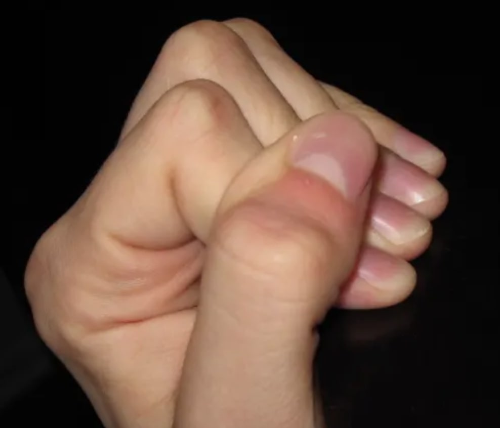 The closed grip position. The distal knuckle at the end of each finger is hyperextended and the intermediate knuckle of each fingers is flexed acutely. The thumb is also placed on top of the index and middle finger to tighten the position further