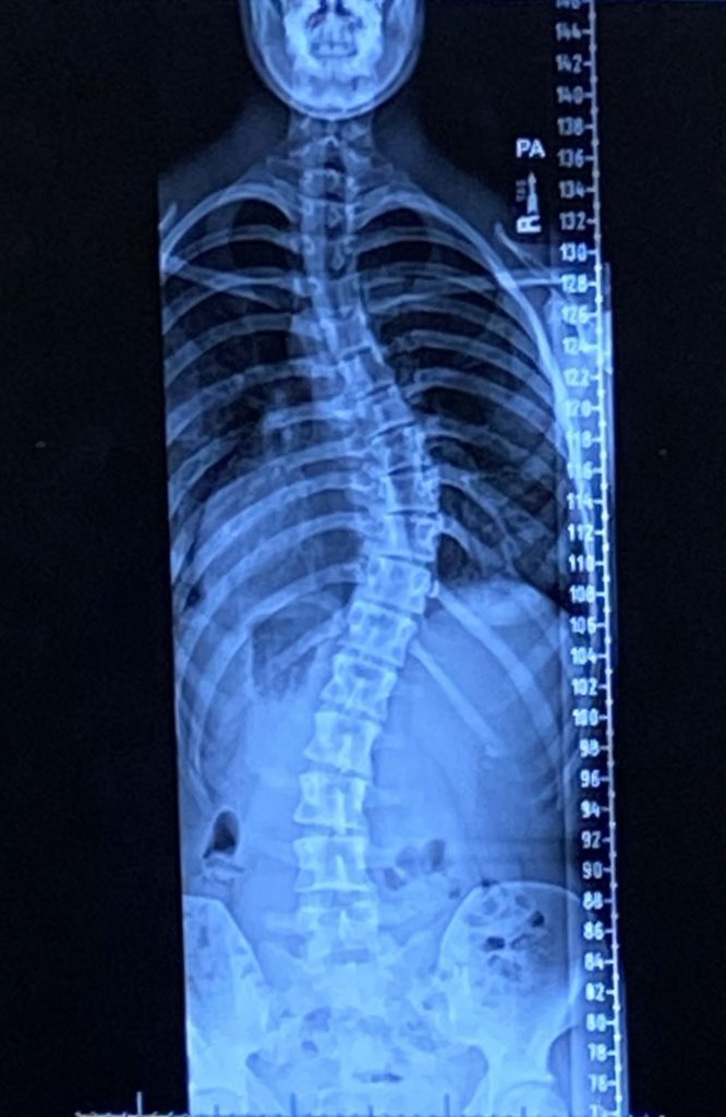 X ray image of a scoliosis s curve with curves in the thoracic and lumbar spine.