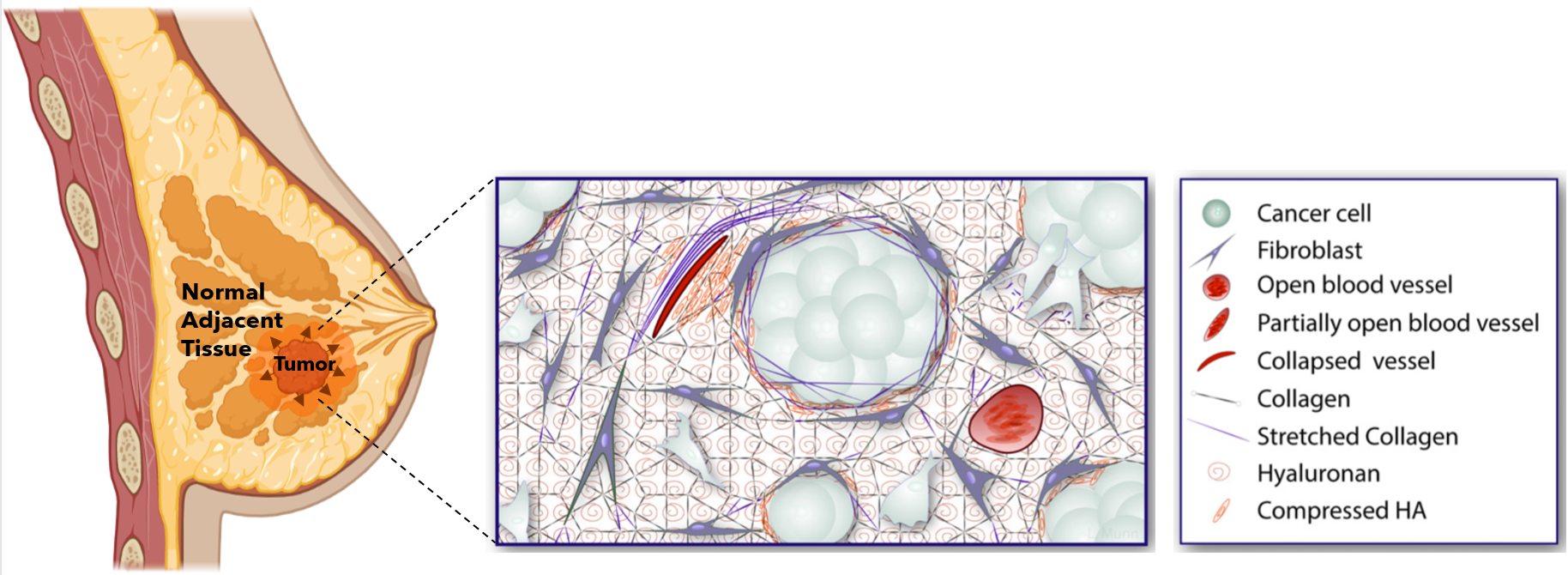 On the left is a breast tumor growing and pushing against the normal adjacent tissue. On the right is a zoomed in view of the breast tumor compressing nearby ECM cells and blood vessels. This results in collapsed or partially open blood vessels, compressed hyaluronan, and stretched collagen. 