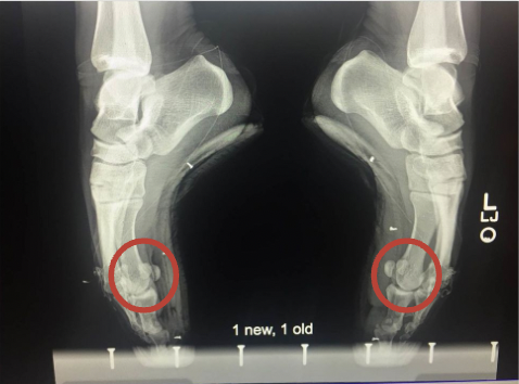 X-Ray of a dancer's feet in pointe shoes. The right foot is in an old shoe and the left foot is in a new shoe.