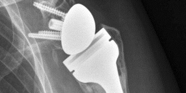 x-ray image showing shoulder replacement