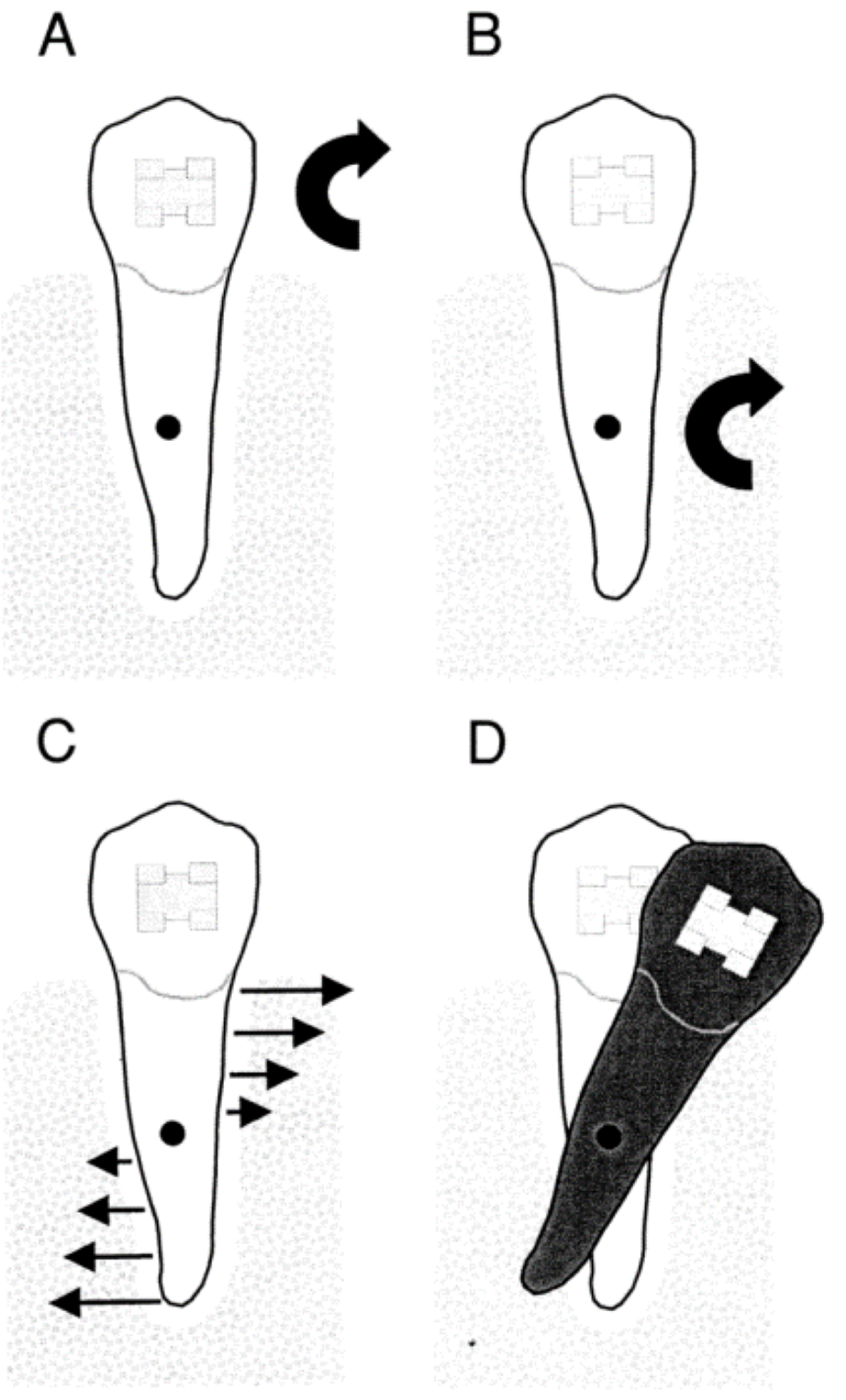 Diagram showing the moment applied to a tooth and its associated tipping movement. 